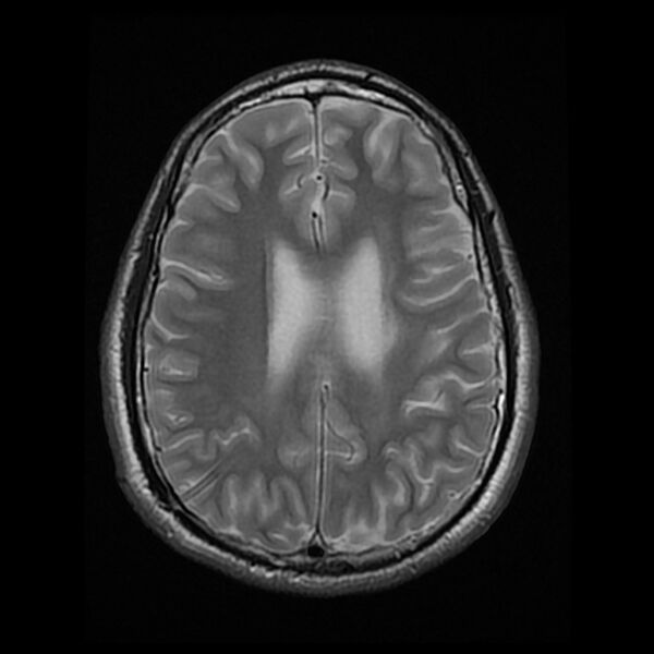 File:Chiasmatic-hypothalamic juvenile pilocytic astrocytoma (Radiopaedia 78533-91235 Axial T2 19).jpg