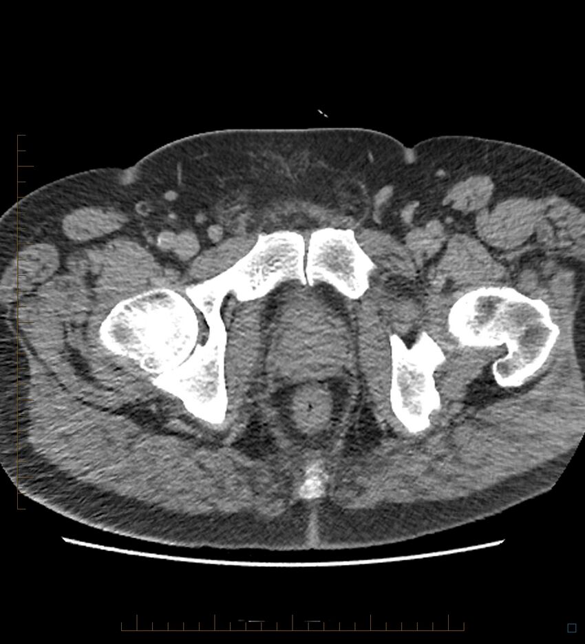 Chicken bone in anal canal (Radiopaedia 51490-57253 Axial non-contrast 9).jpg
