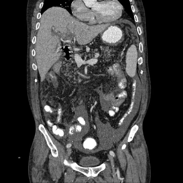 File:Cholangitis and abscess formation in a patient with cholangiocarcinoma (Radiopaedia 21194-21100 C 9).jpg