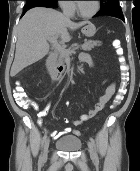 File:Cholecystitis with focal perforation and hepatic abscess (Radiopaedia 37189-38945 Coronal non-contrast 26).png