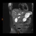 Cholelithiasis with biliary dilatation (Radiopaedia 49442-54589 Coronal T2 13).jpg