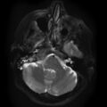 Chondrosarcoma - occipital condyle (Radiopaedia 8969-9744 Axial T2 1).jpg