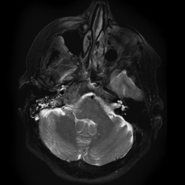 File:Chondrosarcoma - occipital condyle (Radiopaedia 8969-9744 Axial T2 1).jpg