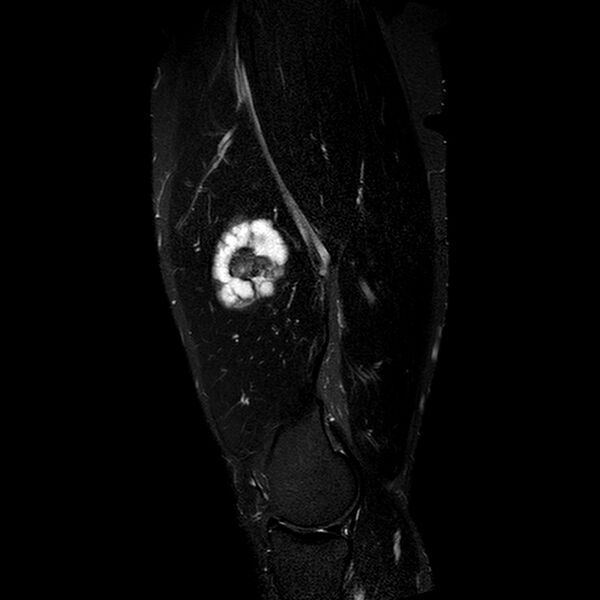 File:Chondrosarcoma arising from exostosis (Radiopaedia 59996-67686 Sagittal STIR 15).jpg