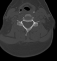 Chordoma (C4 vertebra) (Radiopaedia 47561-52188 Axial bone window 31).png