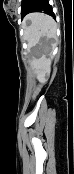 File:Choriocarcinoma liver metastases (Radiopaedia 74768-85766 C 147).jpg