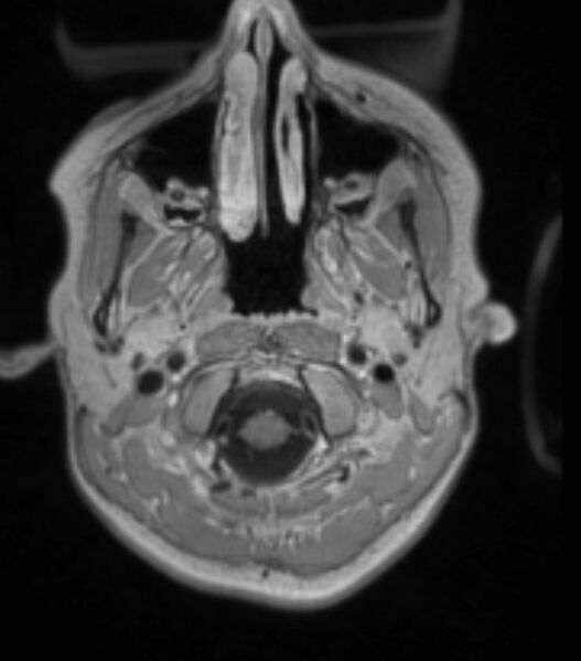 File:Choroid plexus carcinoma (Radiopaedia 91013-108553 Axial T1 C+ 71).jpg