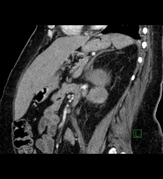 File:Chromophobe renal cell carcinoma (Radiopaedia 84239-99519 D 49).jpg