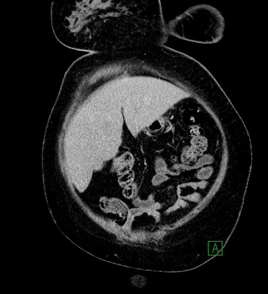 File:Chromophobe renal cell carcinoma (Radiopaedia 84239-99519 F 17).jpg