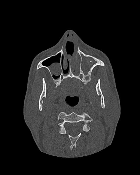 File:Chronic maxillary sinusitis caused by a foreign body (Radiopaedia 58521-65676 Axial bone window 85).jpg