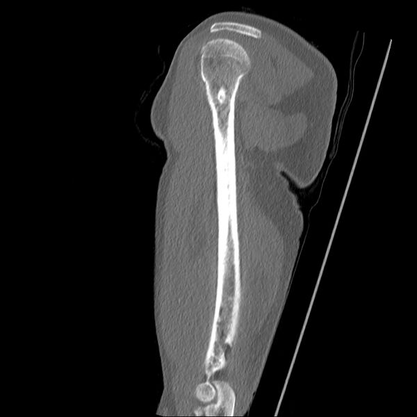 File:Chronic osteomyelitis (Radiopaedia 67597-76998 Sagittal bone window 12).jpg