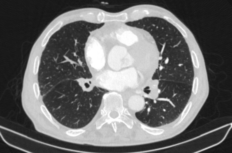 File:Chronic pulmonary embolism (Radiopaedia 91241-108843 Axial lung window 54).jpg