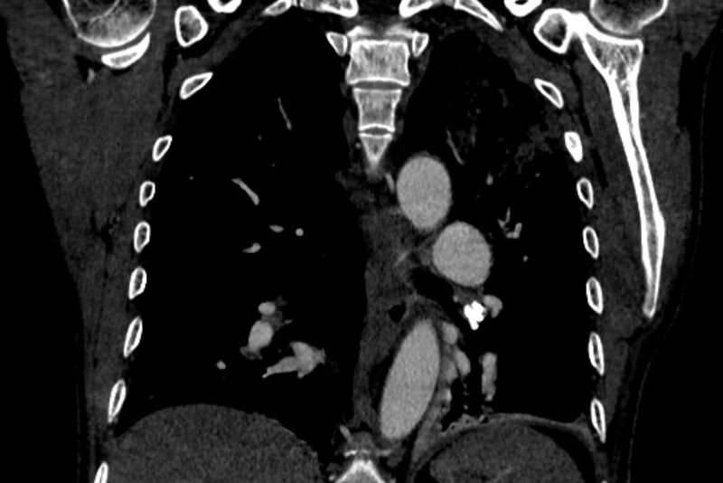 File:Chronic pulmonary embolism with bubbly consolidation (Radiopaedia 91248-108850 B 93).jpg