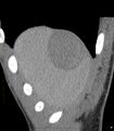 Chronic subcapsular hepatic hematoma (Radiopaedia 29548-30051 B 1).jpg