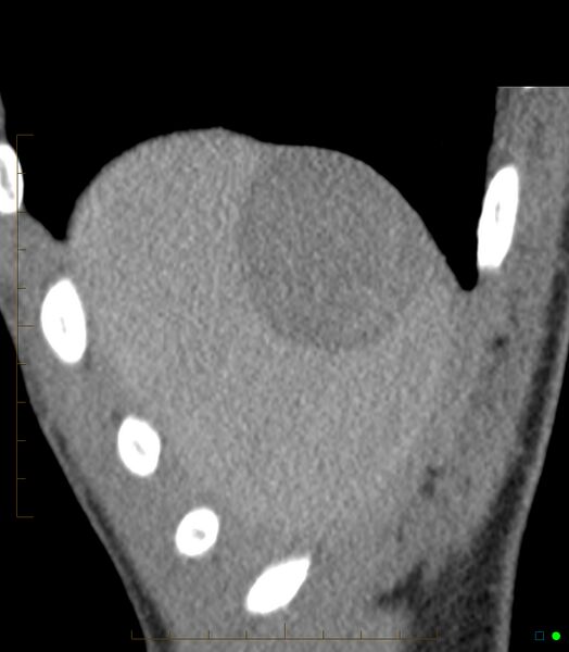 File:Chronic subcapsular hepatic hematoma (Radiopaedia 29548-30051 B 1).jpg