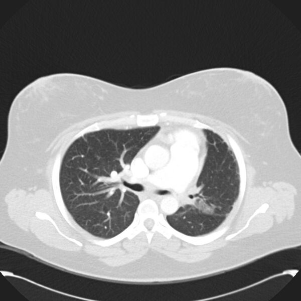File:Chronic thromboembolic pulmonary hypertension (CTEPH) (Radiopaedia 74597-85531 Axial lung window 21).jpg