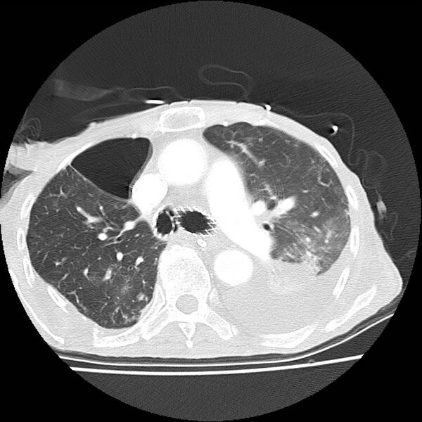 File:Clagett thoracotomy with bronchopleural fistula (Radiopaedia 29192-29587 Axial lung window 20).jpg