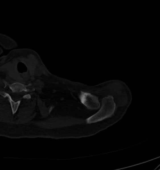 File:Clear cell chondrosarcoma - humerus (Radiopaedia 63104-71612 Axial bone window 9).jpg
