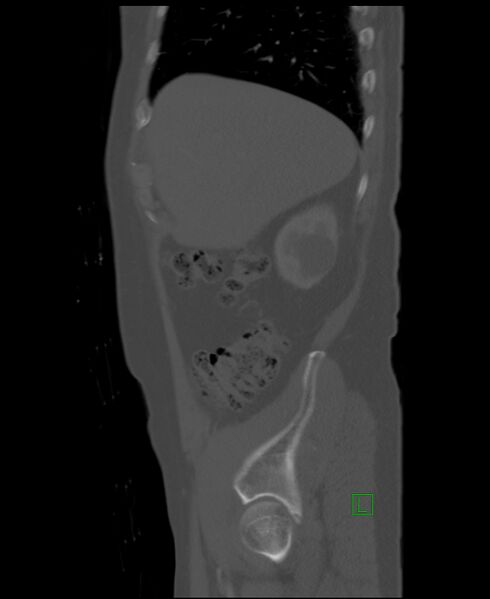 File:Clear cell renal cell carcinoma (Radiopaedia 85006-100539 Sagittal bone window 49).jpg
