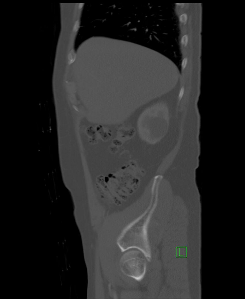 Clear cell renal cell carcinoma (Radiopaedia 85006-100539 Sagittal bone window 49).jpg