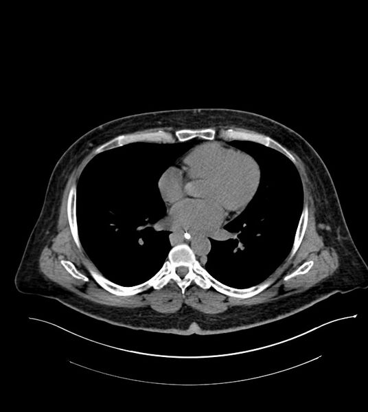 File:Closed-loop small bowel obstruction-internal hernia (Radiopaedia 78439-91096 Axial non-contrast 2).jpg