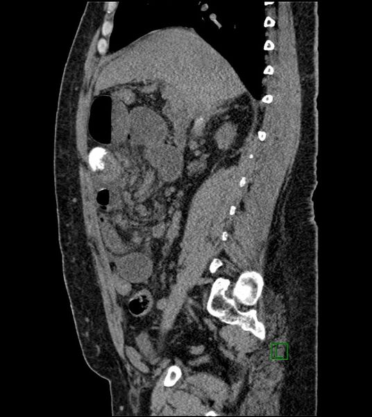 File:Closed-loop small bowel obstruction-internal hernia (Radiopaedia 78439-91096 C 90).jpg