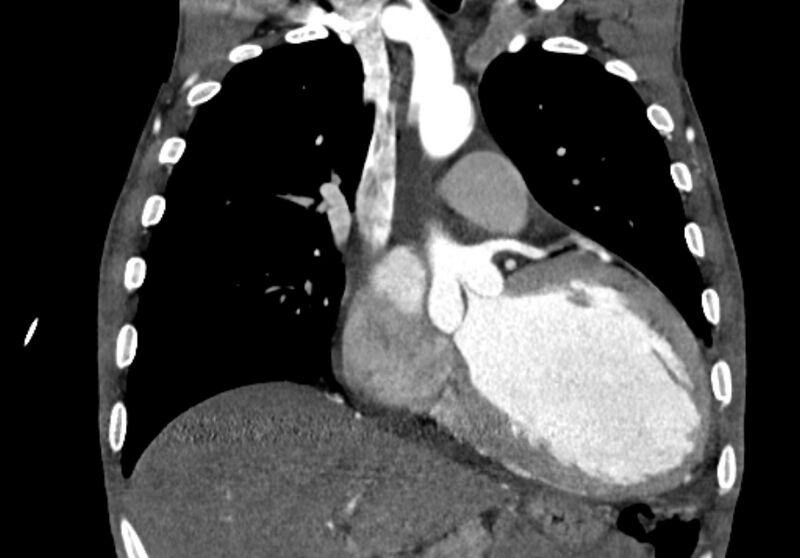 File:Coarctation of aorta with aortic valve stenosis (Radiopaedia 70463-80574 C 89).jpg