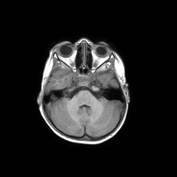 File:Cochlear nerve aplasia - unilateral (Radiopaedia 87910-104413 Axial T1 11).jpg