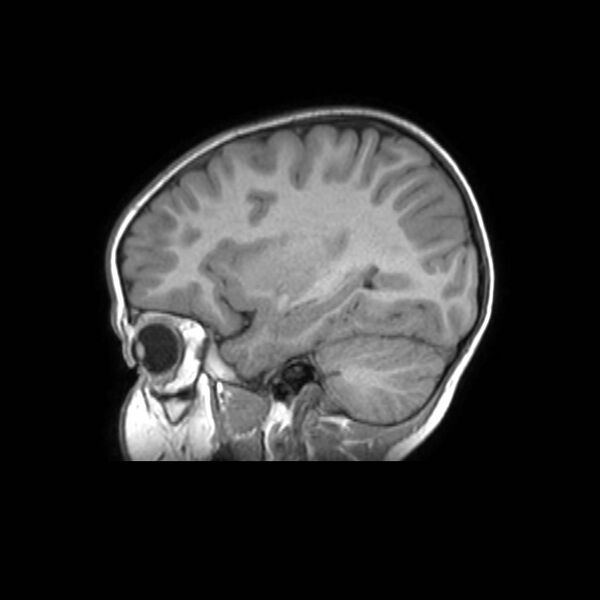 File:Cochlear nerve aplasia - unilateral (Radiopaedia 87910-104413 Sagittal T1 16).jpg