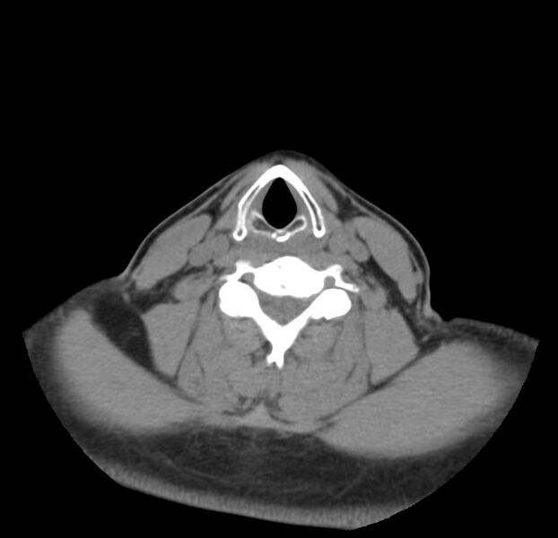 File:Colloid cyst of thyroid (Radiopaedia 22897-22923 Axial non-contrast 34).jpg
