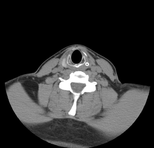 File:Colloid cyst of thyroid (Radiopaedia 22897-22923 Axial non-contrast 36).jpg
