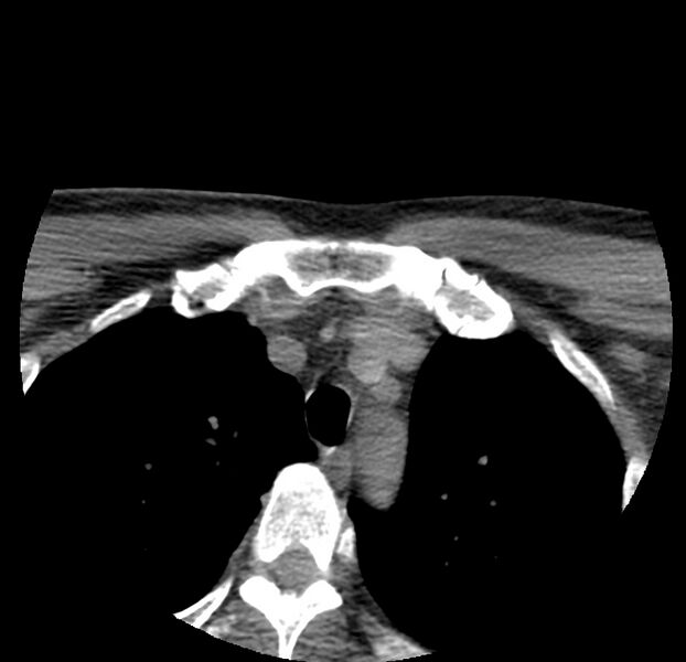 File:Colloid cyst of thyroid (Radiopaedia 22897-22923 Axial non-contrast 59).jpg