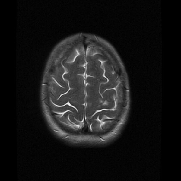 File:Colloid cyst with hydrocephalus (Radiopaedia 9373-10065 Axial T2 17).jpg