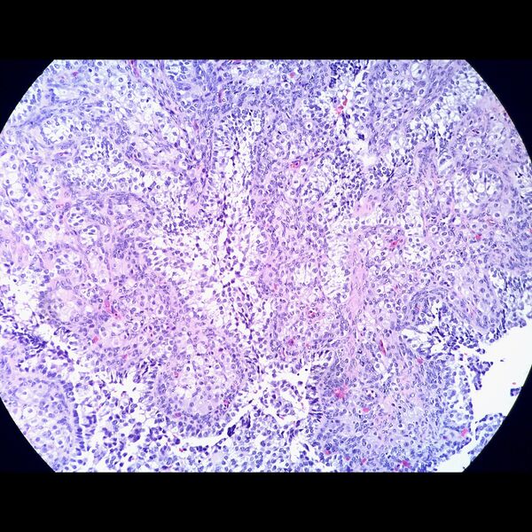 File:Juvenile granulosa cell tumor of the ovary (histology) (Radiopaedia 77922).jpeg
