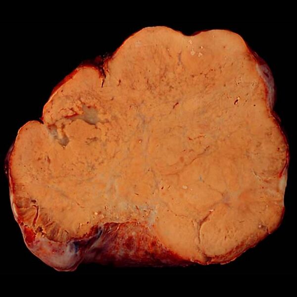 File:Krukenburg tumor of ovary (gross pathology) (Radiopaedia 9582).jpg