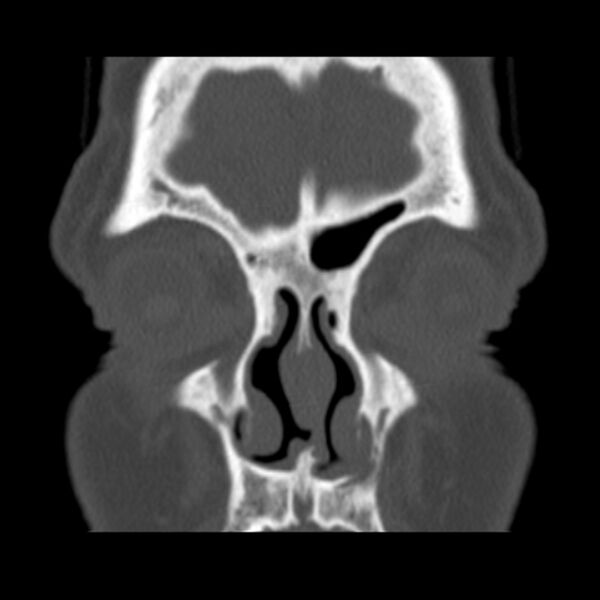 File:Nasolabial cyst (Radiopaedia 33987-35205 Coronal bone window 25).jpg