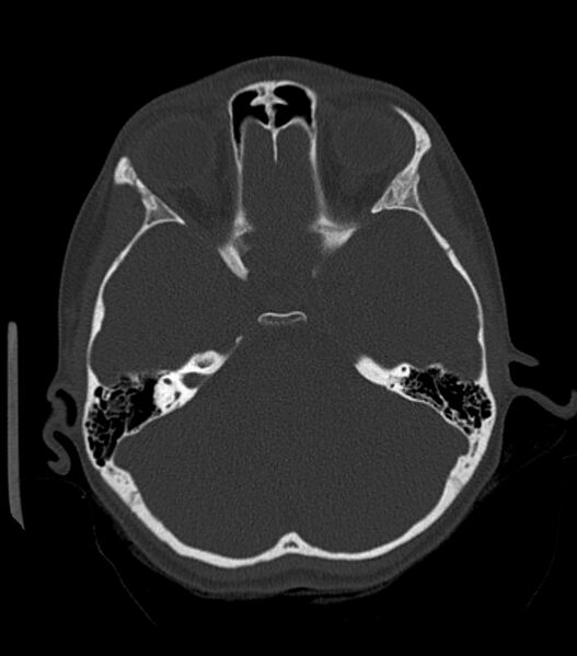 File:Nasoorbitoethmoid fracture (Radiopaedia 90044-107205 Axial bone window 86).jpg