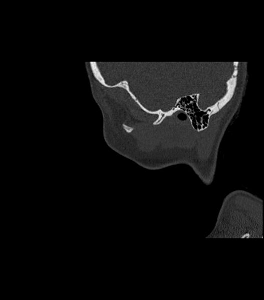 File:Nasoorbitoethmoid fracture (Radiopaedia 90044-107205 Sagittal bone window 22).jpg