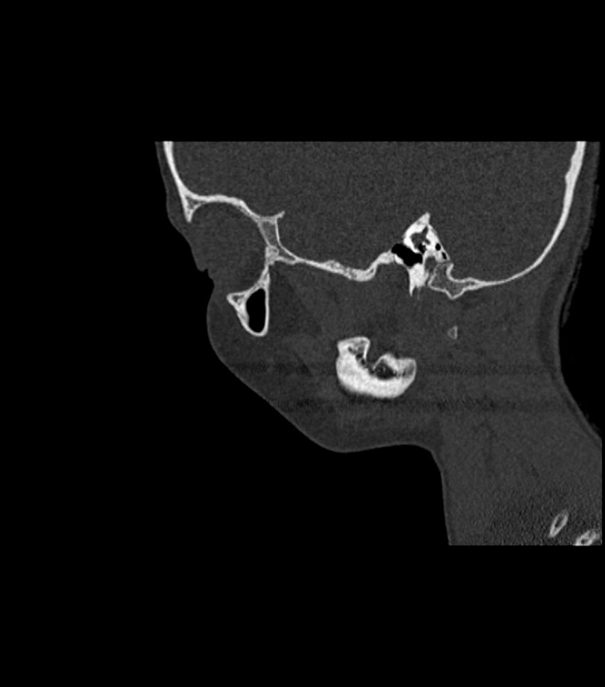 Nasoorbitoethmoid fracture (Radiopaedia 90044-107205 Sagittal bone window 39).jpg