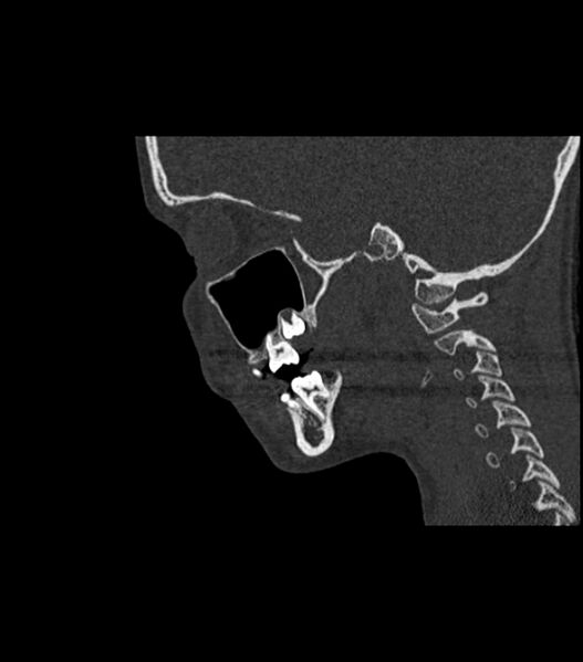 File:Nasoorbitoethmoid fracture (Radiopaedia 90044-107205 Sagittal bone window 55).jpg
