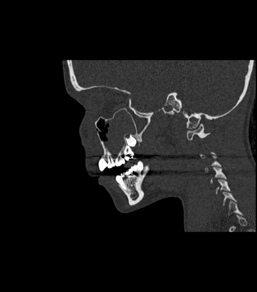File:Nasoorbitoethmoid fracture (Radiopaedia 90044-107205 Sagittal bone window 94).jpg