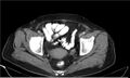 Necrotizing pancreatitis (Radiopaedia 20595-20495 A 41).jpg