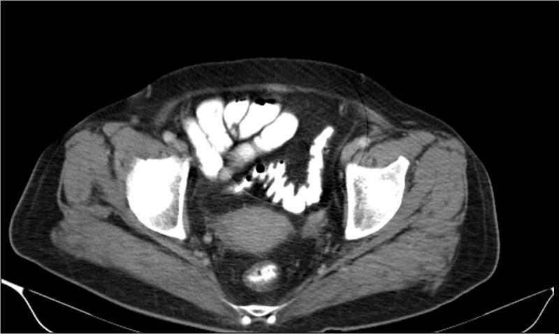 File:Necrotizing pancreatitis (Radiopaedia 20595-20495 A 41).jpg