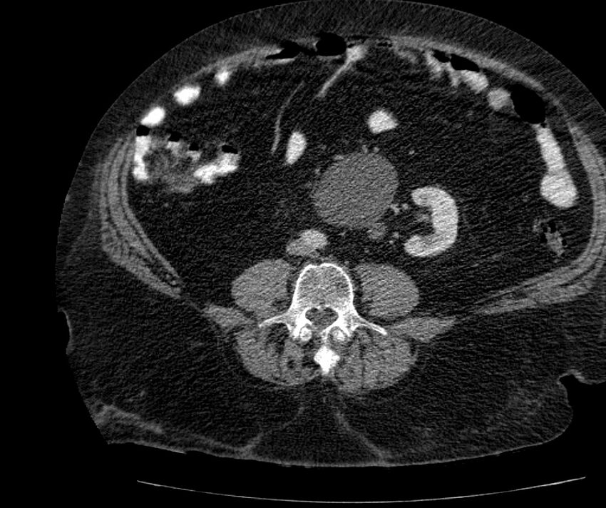 Nephroptosis with inguinal hernia containing perirenal fat (Radiopaedia 56632-63391 C 209).jpg