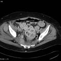 Nerve sheath tumor - malignant - sacrum (Radiopaedia 5219-6987 A 9).jpg