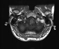 Neurofibromatosis type 1 (Radiopaedia 80355-93740 Axial T1 1).jpg