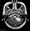 Neurofibromatosis type 2 - cranial and spinal involvement (Radiopaedia 5351-7111 Axial T1 C+ 2).jpg