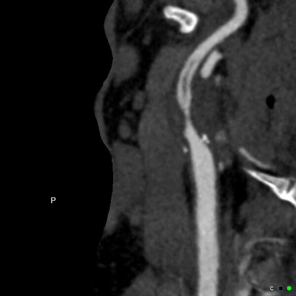 File:Non-occlusive intraluminal internal carotid artery thrombus (Radiopaedia 37751-39658 A 10).jpg