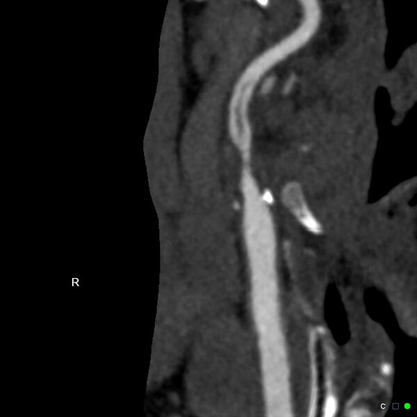 File:Non-occlusive intraluminal internal carotid artery thrombus (Radiopaedia 37751-39658 A 6).jpg