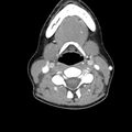 Normal CT of the neck (Radiopaedia 14575-14500 Axial C+ 38).jpg
